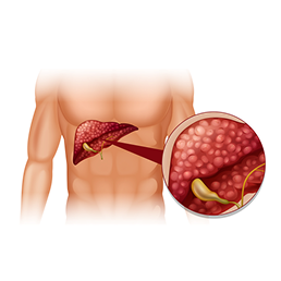 Bile duct cancer