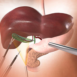 Hepaticobiliary surgery