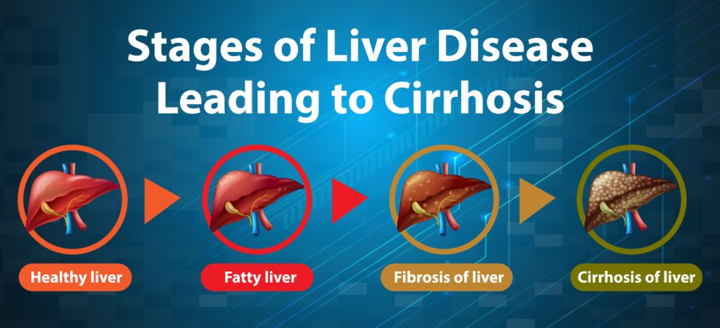 stages of liver diseases