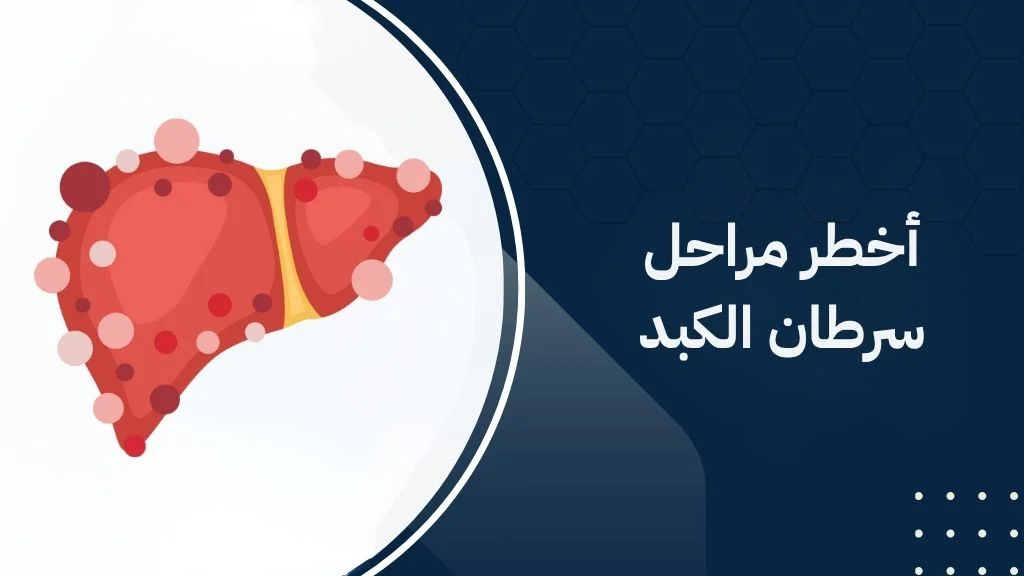 أخطر مراحل سرطان الكبد