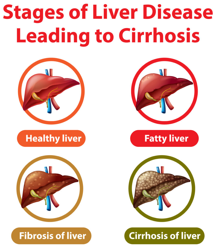 Stages of liver disease leading to Cirrhosis