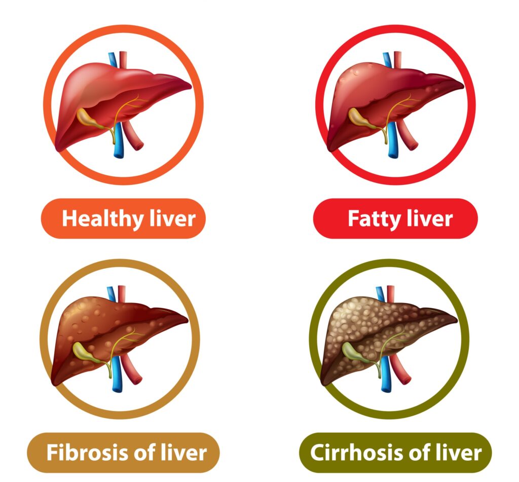 Stages of liver disease leading to Cirrhosis