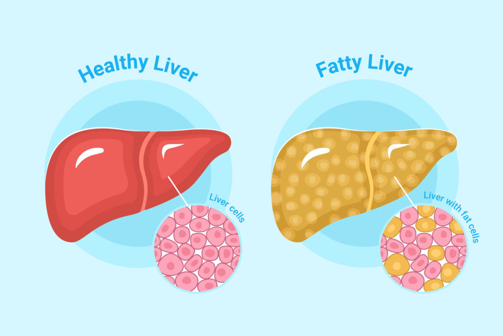Understanding Grade 1 Fatty liver