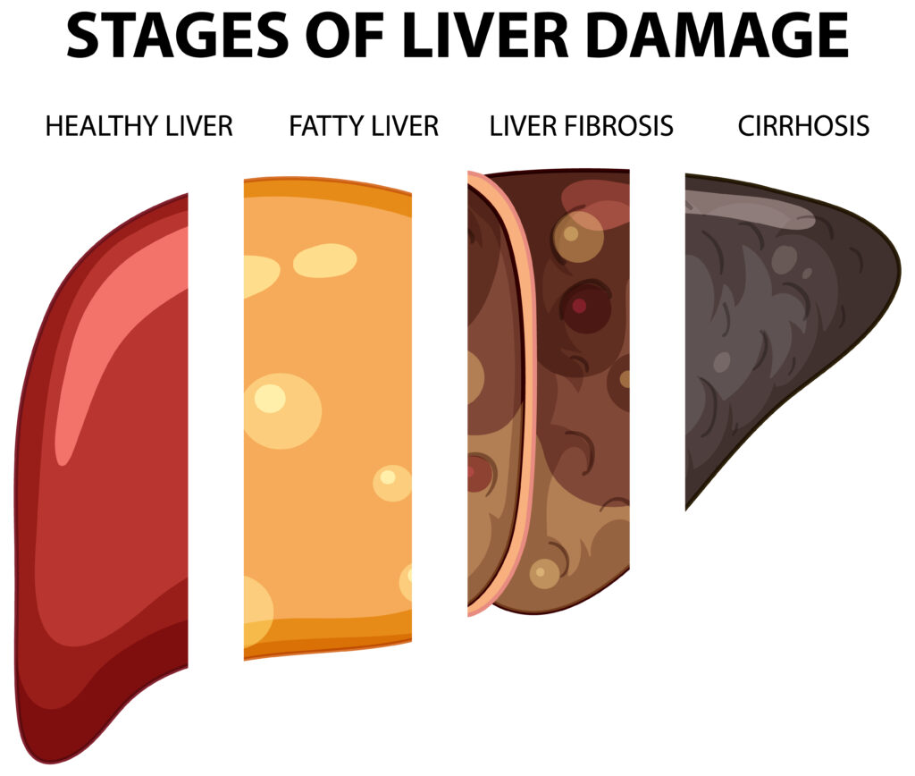 Liver Cirrhosis and Its Impact on Skin: Symptoms Explained