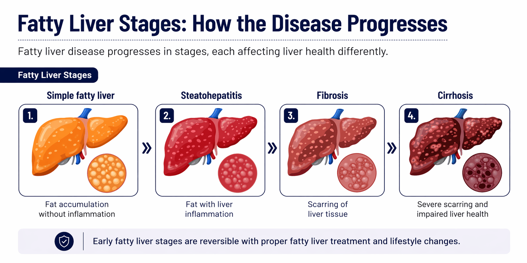 fatty liver stages