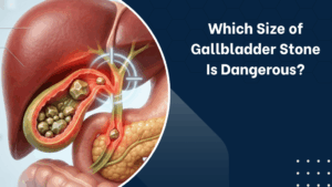 Which Size of Gallbladder Stone Is Dangerous?